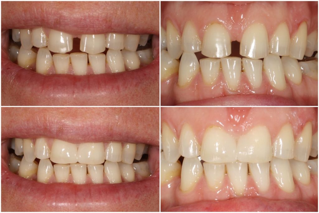 Before & After Cosmetic Bonding